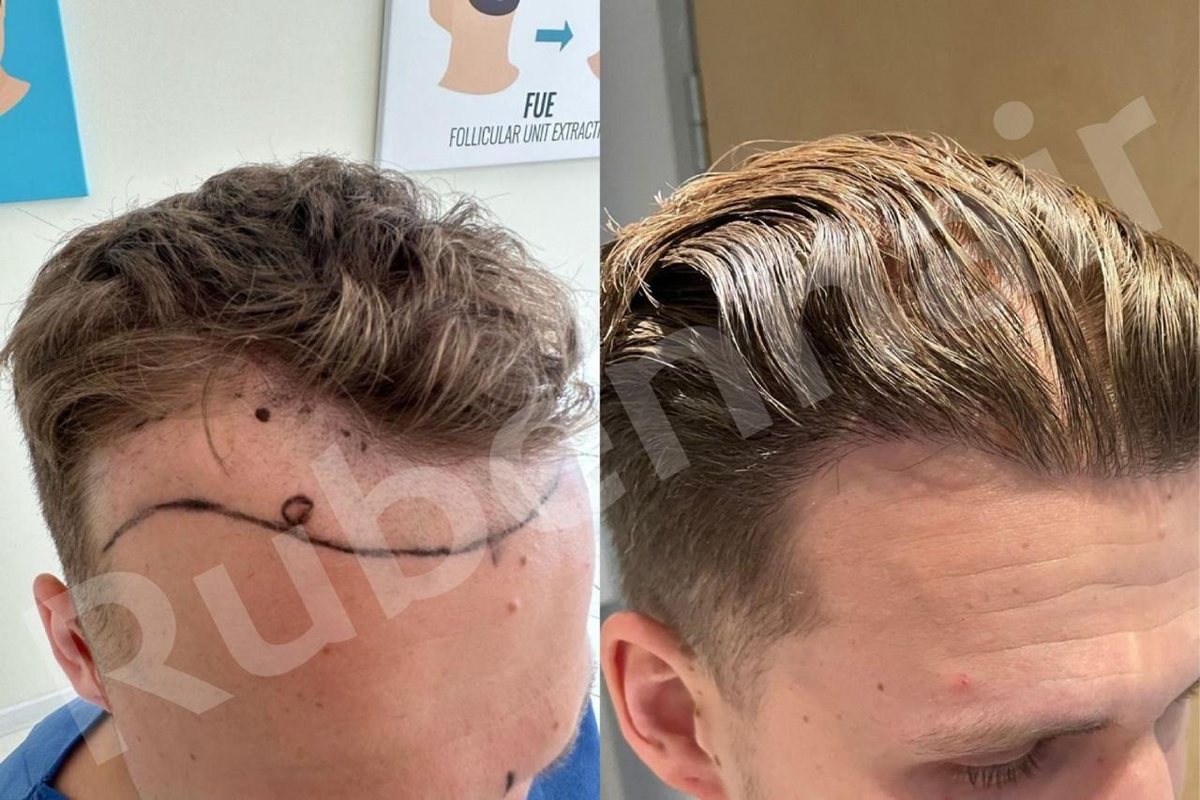 Plaukų linijos rekonstrukcija — Prieš / Po